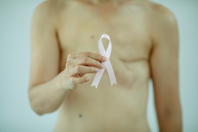Mastectomy