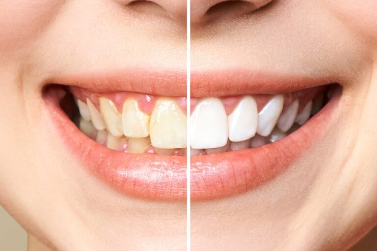 Teeth Whitening: How it Works and What it Costs