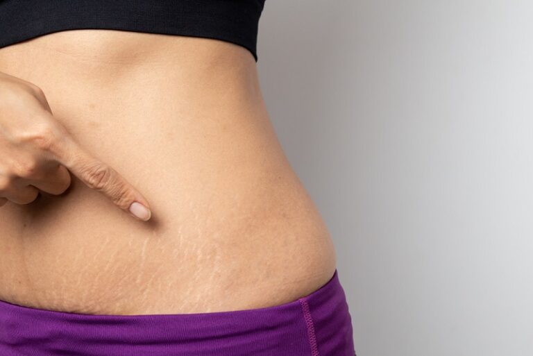 The Definitive Guide to Natural Scrubs for Stretch Marks