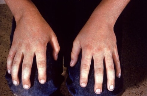 How Long Can Parvo Live On Human Skin